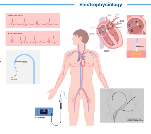 Electrophysiology study