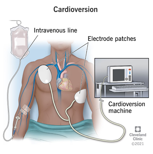 Cardioversion