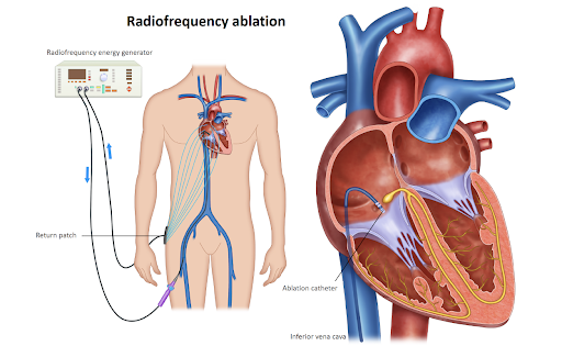 Cardiac arrhythmias Ablation