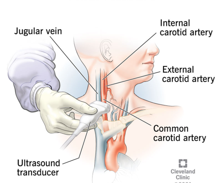 Carotid duplex