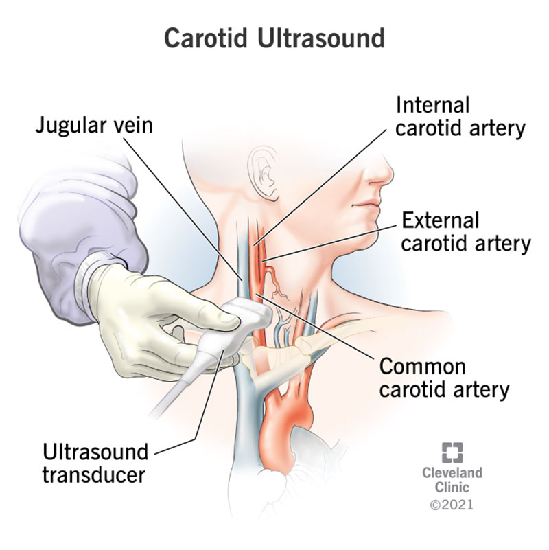 Carotid duplex