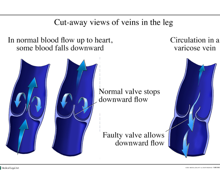 Venous insufficiency