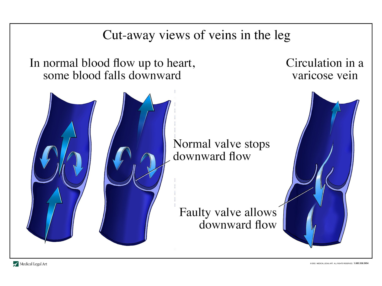 Venous insufficiency
