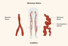 Sclerotherapy