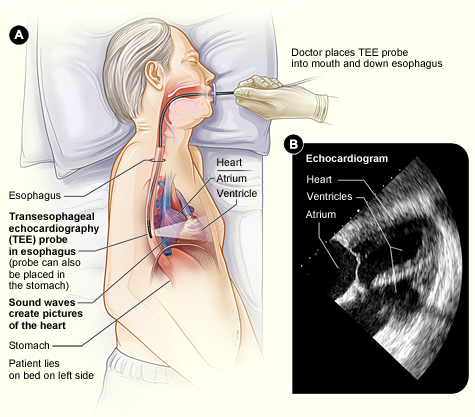 Transesophageal echocardiogram