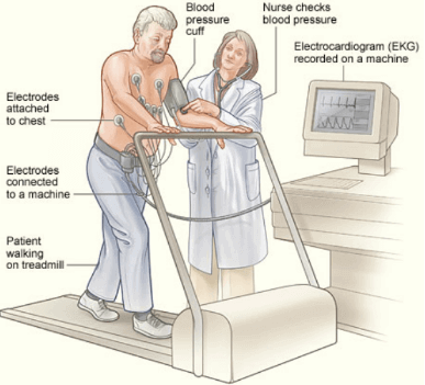 Treadmill stress test