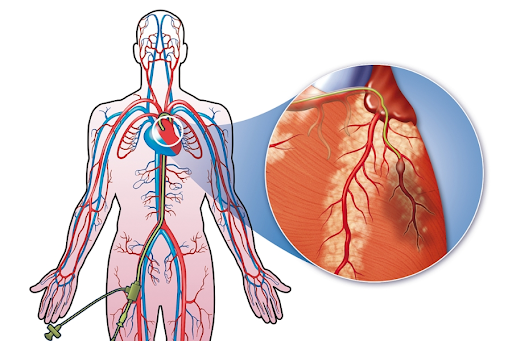 Cardiac catheterisation